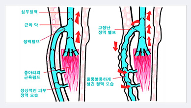 정상적인 정맥모습과 정맥류가 생긴 모습