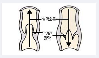 판막이 망가져 혈액이 역류