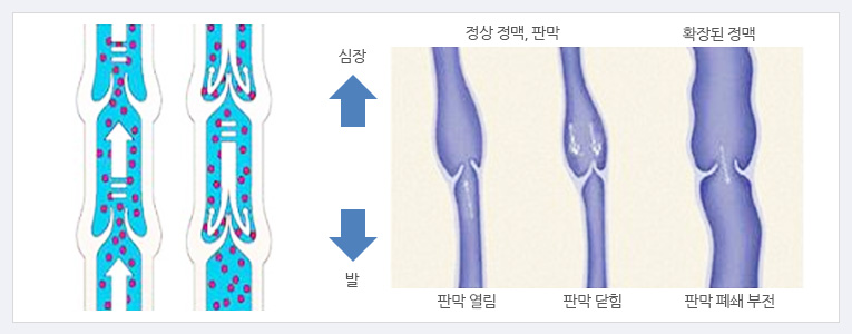 정상 정맥,판막_판막 열림, 판막 닫힘, 확장된 정맥 판맥_폐쇄 부전