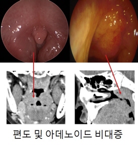 편도및아데노이드비대증