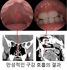 만성구호흡