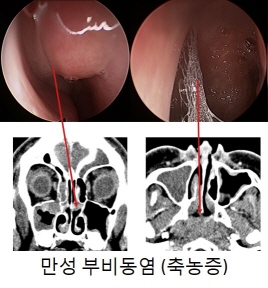 만성부비동염